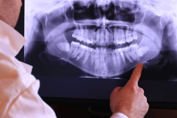 Best Knocked-Out Tooth (Avulsed Tooth) Treatment in Hannibal, MO